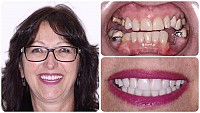 Teeth-In-1-Day Same Day Dental Implants Gallery Image