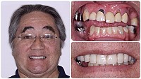Teeth-In-1-Day Same Day Dental Implants Gallery Image