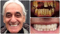 Dental Implants Gallery Image