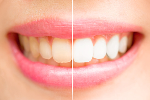 Teeth Whitening Service Image