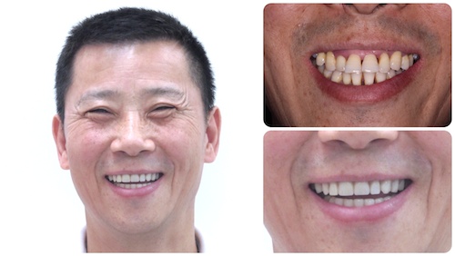 cheap dental implants Toronto