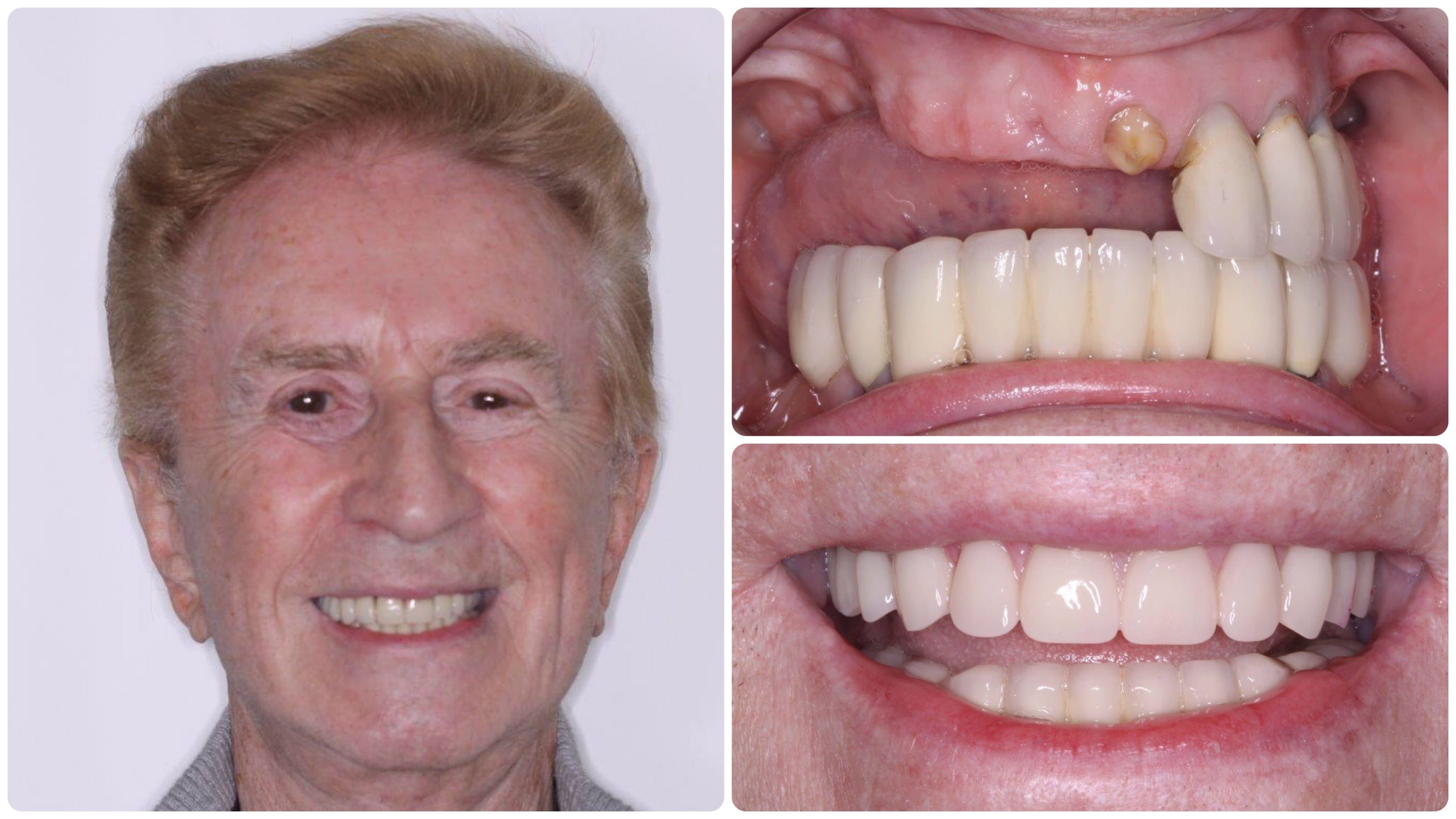 Dental Implants Toronto