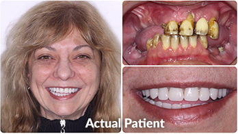 Dental Implants Toronto Before and After 