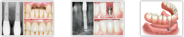 Toronto Dental Implants